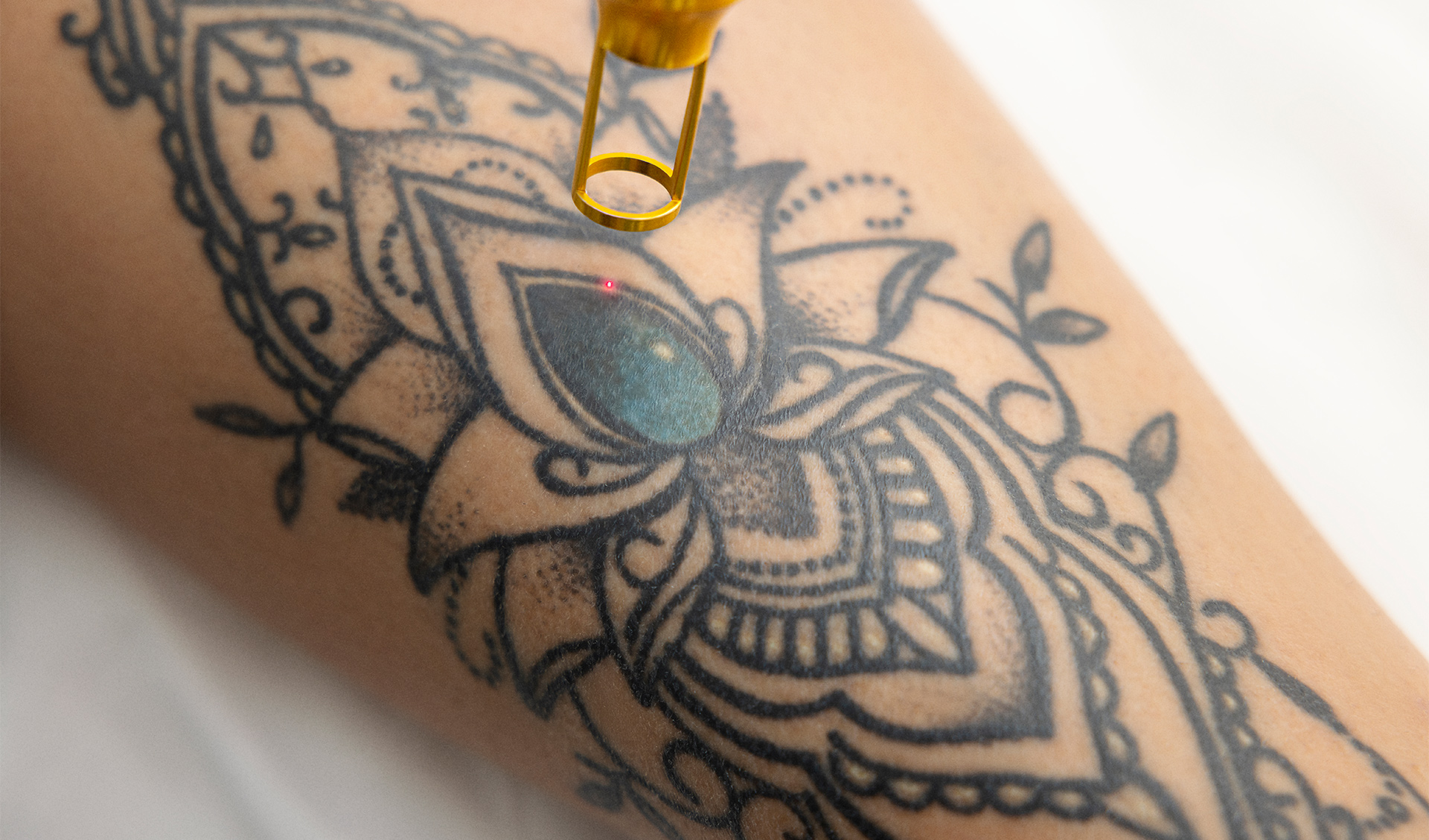 Laser Tattoo Removal in Dubai | Safe & Effective Solutions